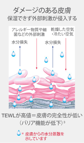 illustration-of-unhealthy-skin-layers-caused-by-water-loss